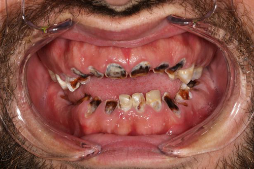 мужчина лишился почти всех зубов