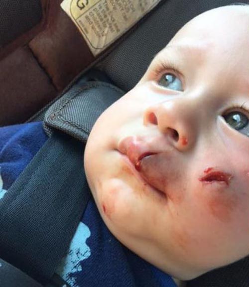дрон повредил лицо ребёнку