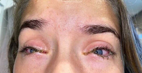 allergy to eyelash extensions