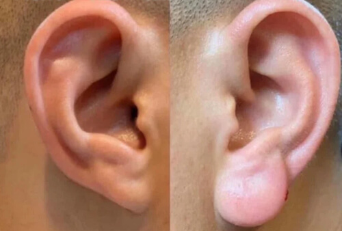 увеличение мочек ушей
