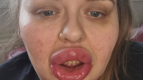 аллергия на губные филлеры