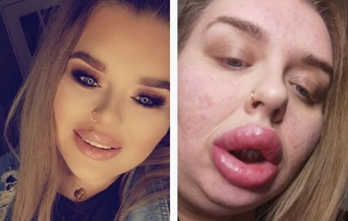 allergy to lip fillers