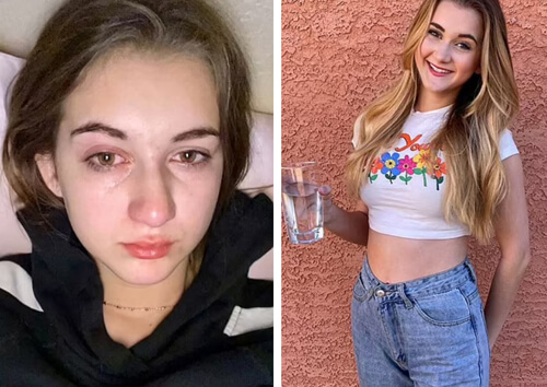 the girl has a rare allergy to water
