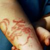 аллергия на татуировку хной