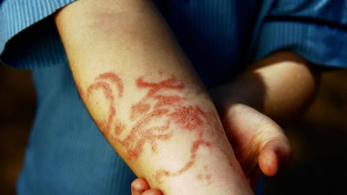 henna tattoo allergy