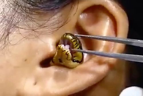 извлечение змеи из уха женщины