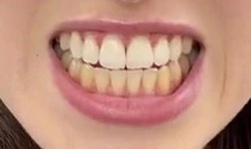 отбеливание верхних зубов
