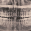 рентгеновский снимок зубов 