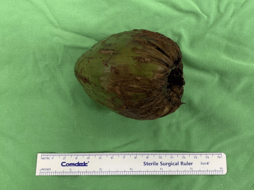 кокосовый орех в заднем проходе