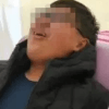мужчина с некрозом кишечника 