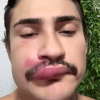 выдавил прыщ на губе 